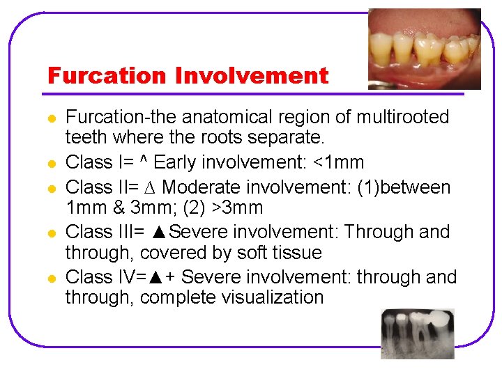 Furcation Involvement l l l Furcation-the anatomical region of multirooted teeth where the roots