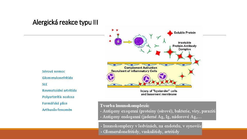 Alergická reakce typu III Sérová nemoc Glomerulonefritida SLE Revmatoidní artritida Polyarteritis nodosa Farmářská plíce