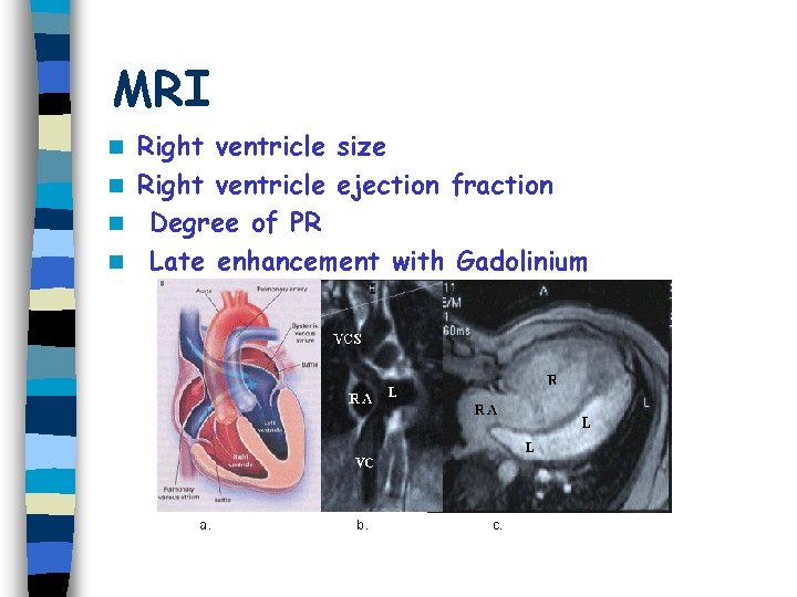MRI Right ventricle size n Right ventricle ejection fraction n Degree of PR n