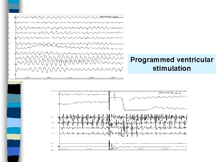 Programmed ventricular stimulation 