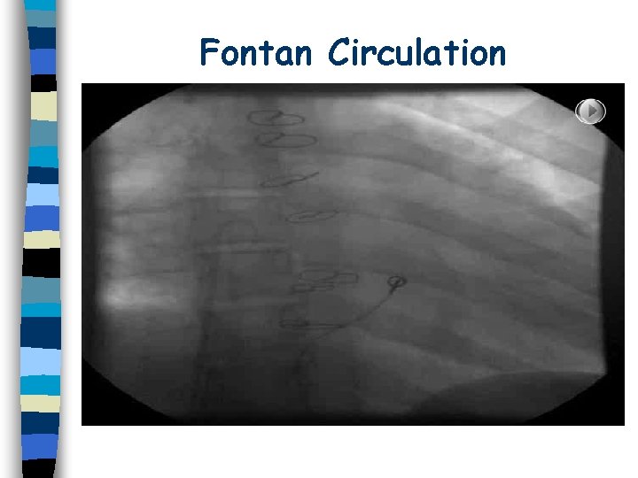 Fontan Circulation 