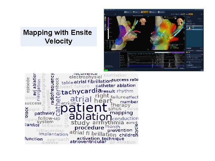 Mapping with Ensite Velocity 