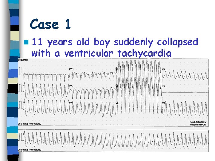 Case 1 n 11 years old boy suddenly collapsed with a ventricular tachycardia 