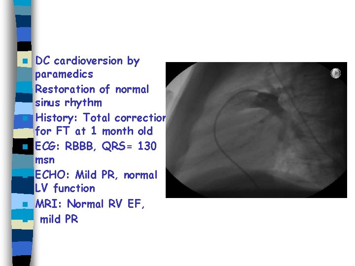 n n n n DC cardioversion by paramedics Restoration of normal sinus rhythm History: