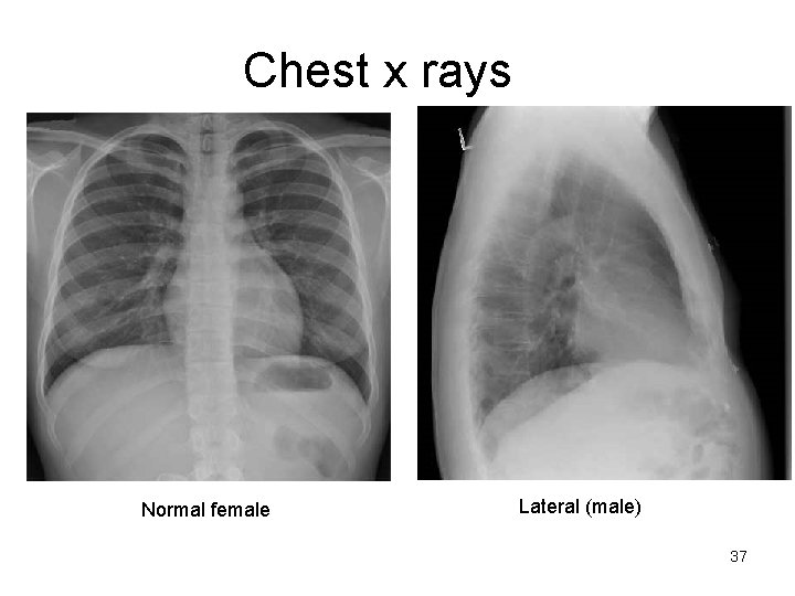 Chest x rays Normal female Lateral (male) 37 