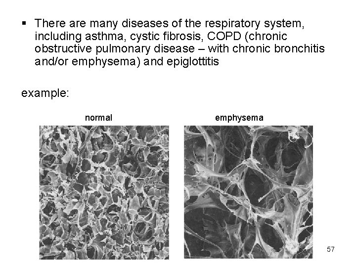 § There are many diseases of the respiratory system, including asthma, cystic fibrosis, COPD