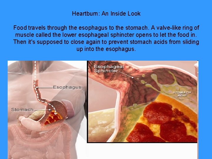 Heartburn: An Inside Look Food travels through the esophagus to the stomach. A valve-like