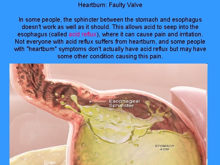 Heartburn: Faulty Valve In some people, the sphincter between the stomach and esophagus doesn't