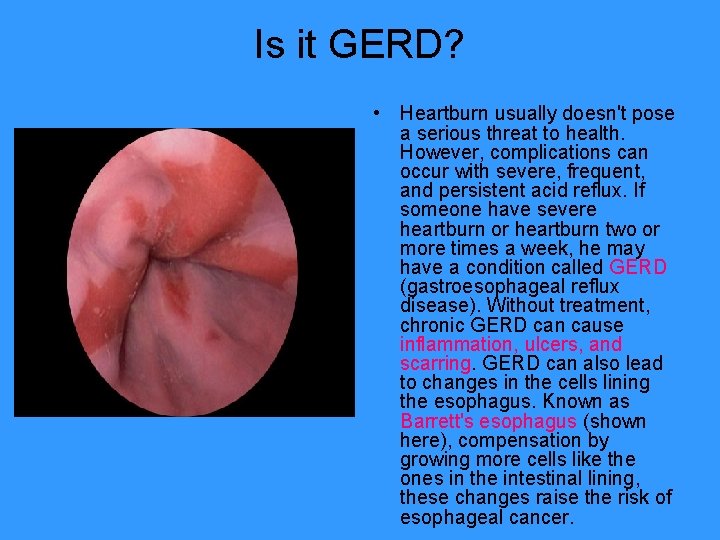 Is it GERD? • Heartburn usually doesn't pose a serious threat to health. However,