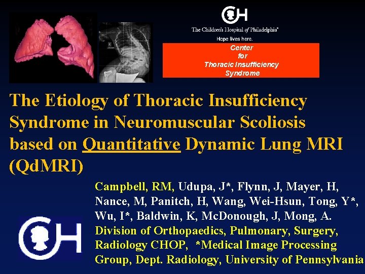Center for Thoracic Insufficiency Syndrome The Etiology of Thoracic Insufficiency Syndrome in Neuromuscular Scoliosis