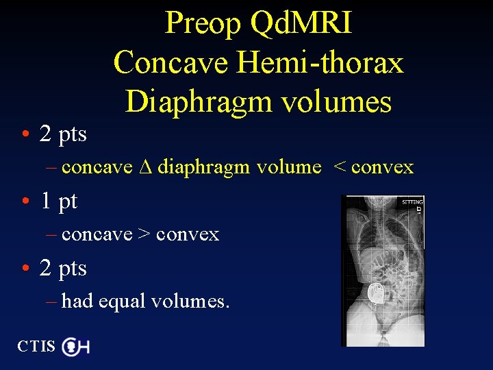Preop Qd. MRI Concave Hemi-thorax Diaphragm volumes • 2 pts – concave ∆ diaphragm