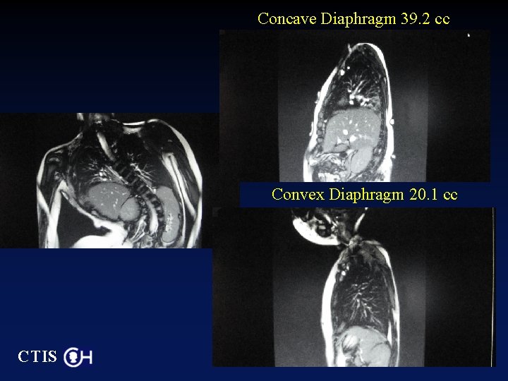 Concave Diaphragm 39. 2 cc Convex Diaphragm 20. 1 cc CTIS 