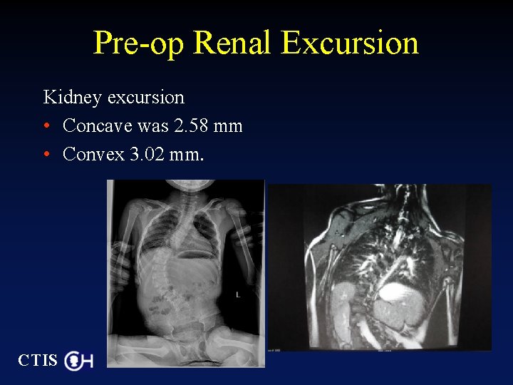 Pre-op Renal Excursion Kidney excursion • Concave was 2. 58 mm • Convex 3.