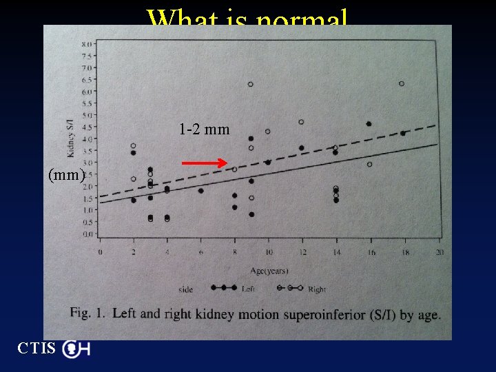 What is normal superior/inferior reanl motion? 1 -2 mm (mm) CTIS 