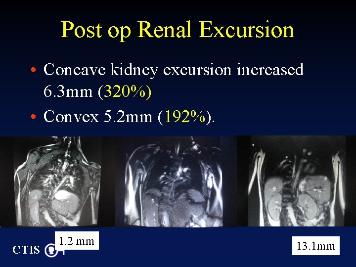 Post op Renal Excursion • Concave kidney excursion increased 6. 3 mm (320%) •