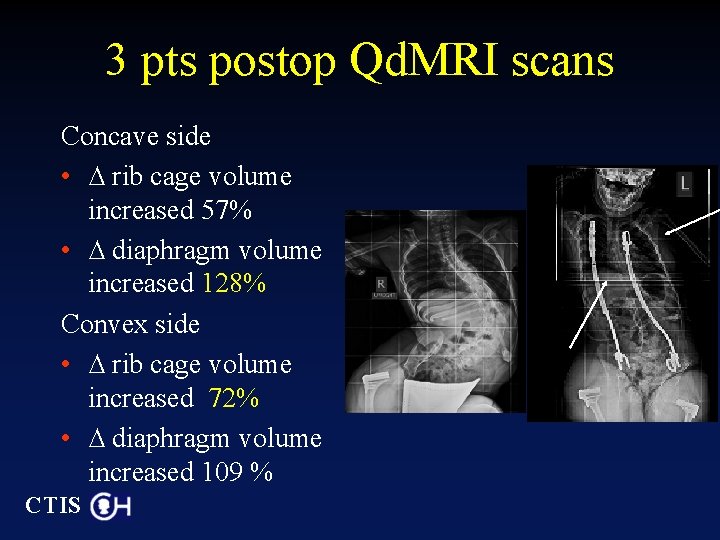 3 pts postop Qd. MRI scans Concave side • ∆ rib cage volume increased