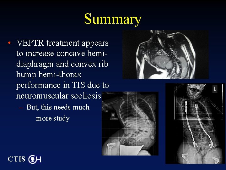 Summary • VEPTR treatment appears to increase concave hemidiaphragm and convex rib hump hemi-thorax