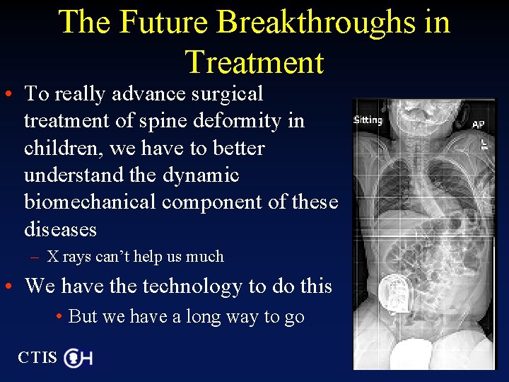 The Future Breakthroughs in Treatment • To really advance surgical treatment of spine deformity
