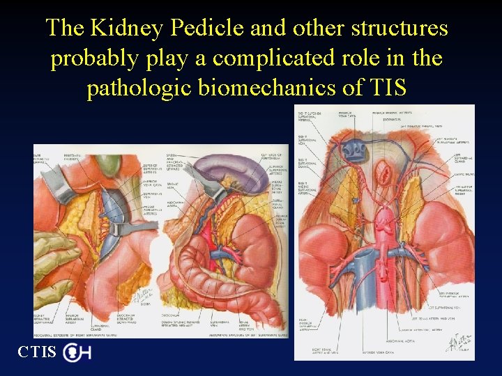 The Kidney Pedicle and other structures probably play a complicated role in the pathologic