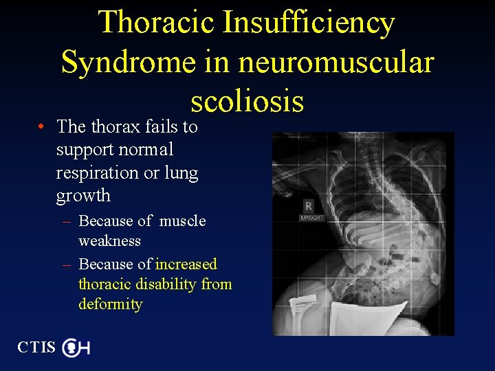 Thoracic Insufficiency Syndrome in neuromuscular scoliosis • The thorax fails to support normal respiration