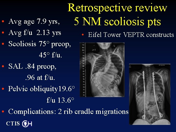 Retrospective review 5 NM scoliosis pts • Avg age 7. 9 yrs, • Avg