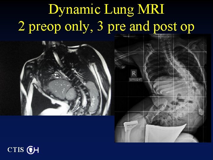 Dynamic Lung MRI 2 preop only, 3 pre and post op CTIS 