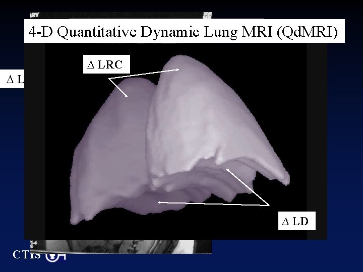 Dynamic Lung MRILung (d. MRI) 4 -D Quantitative Dynamic MRI (Qd. MRI) ∆ LRC