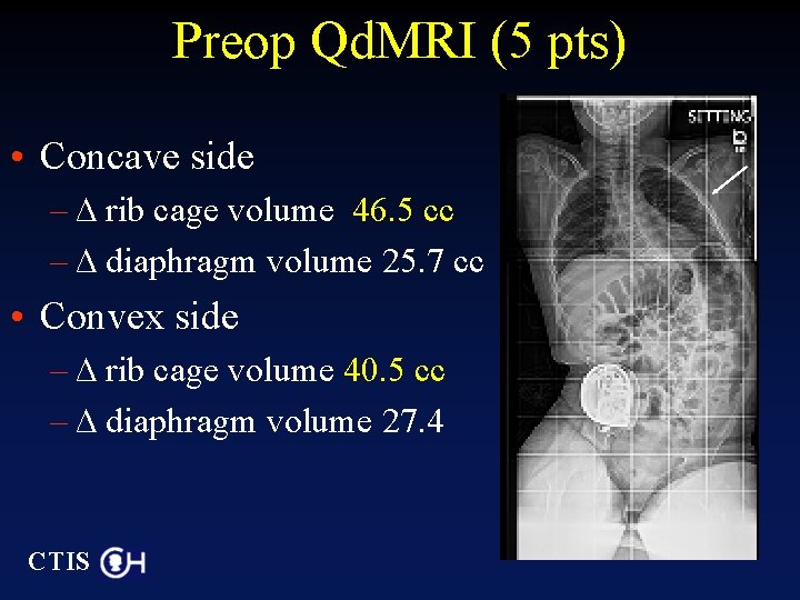 Preop Qd. MRI (5 pts) • Concave side – ∆ rib cage volume 46.