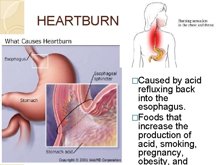 HEARTBURN �Caused by acid refluxing back into the esophagus. �Foods that increase the production