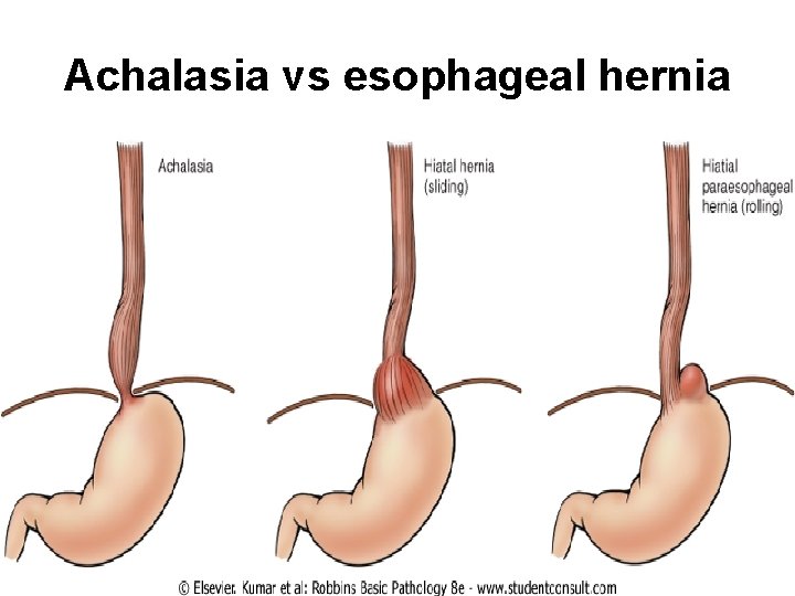 Achalasia vs esophageal hernia Achalasia vs esophageal hernia