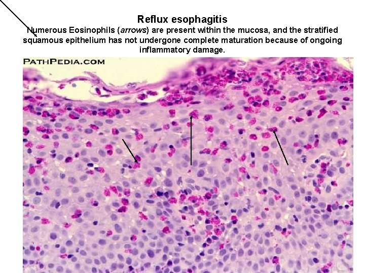 Reflux esophagitis Numerous Eosinophils (arrows) are present within the mucosa, and the stratified squamous Reflux esophagitis Numerous Eosinophils (arrows) are present within the mucosa, and the stratified squamous
