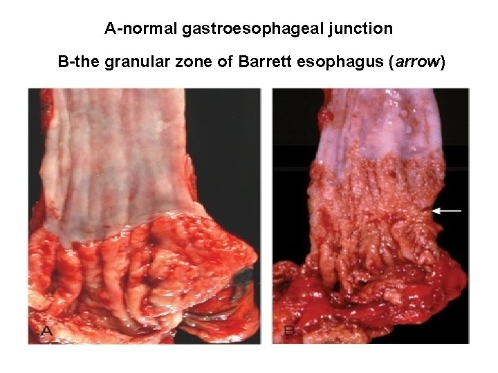 A-normal gastroesophageal junction B-the granular zone of Barrett esophagus (arrow) A-normal gastroesophageal junction B-the granular zone of Barrett esophagus (arrow)