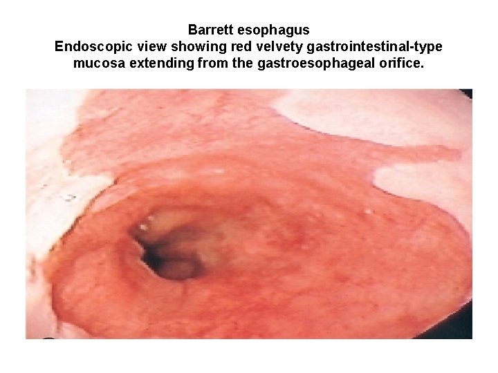 Barrett esophagus Endoscopic view showing red velvety gastrointestinal-type mucosa extending from the gastroesophageal orifice. Barrett esophagus Endoscopic view showing red velvety gastrointestinal-type mucosa extending from the gastroesophageal orifice.