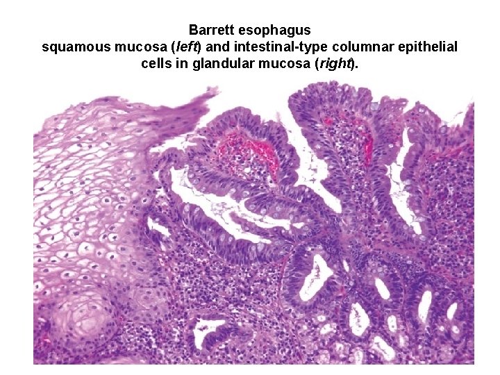 Barrett esophagus squamous mucosa (left) and intestinal-type columnar epithelial cells in glandular mucosa (right). Barrett esophagus squamous mucosa (left) and intestinal-type columnar epithelial cells in glandular mucosa (right).