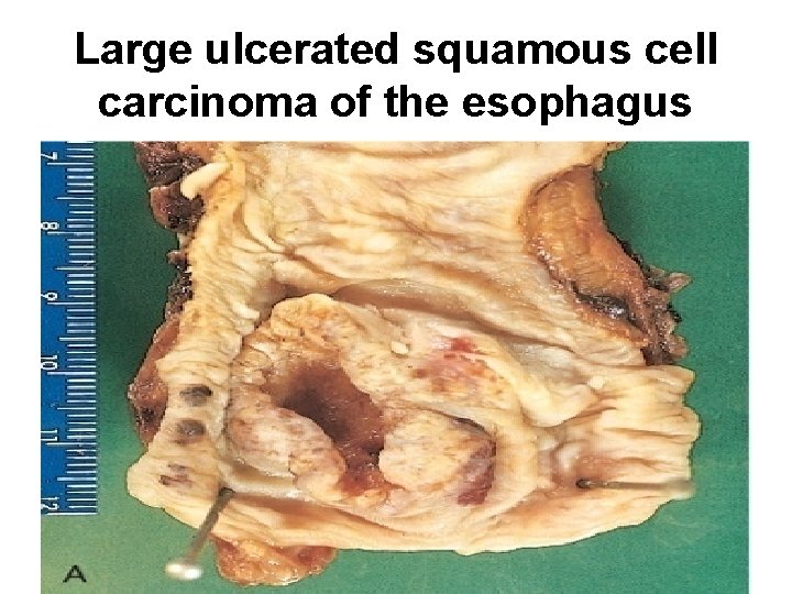 Large ulcerated squamous cell carcinoma of the esophagus Large ulcerated squamous cell carcinoma of the esophagus