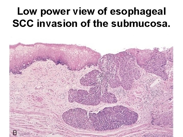 Low power view of esophageal SCC invasion of the submucosa. Low power view of esophageal SCC invasion of the submucosa.