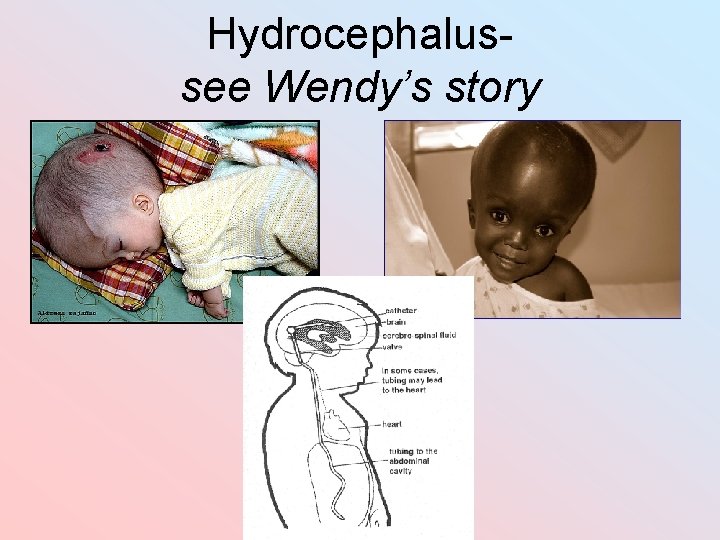 Hydrocephalussee Wendy’s story 