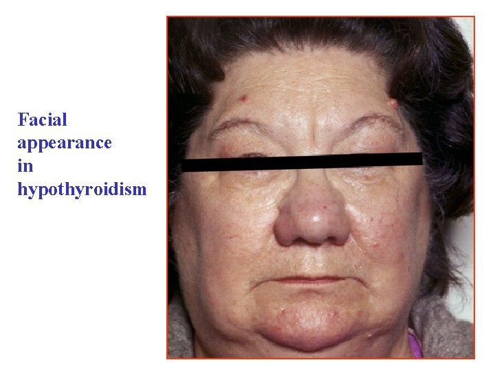 Facial appearance in hypothyroidism 