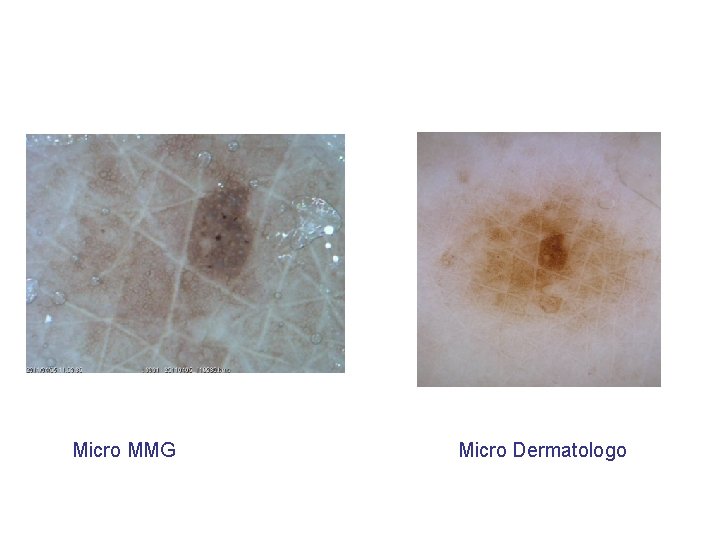 Micro MMG Micro Dermatologo 