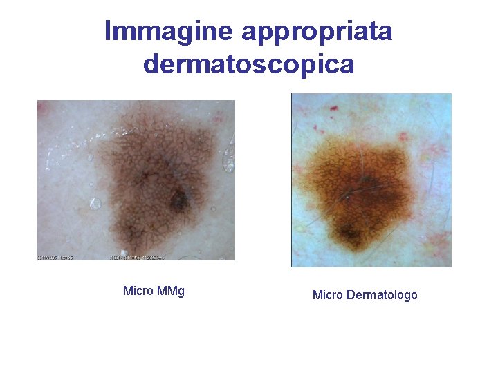 Immagine appropriata dermatoscopica Micro MMg Micro Dermatologo 