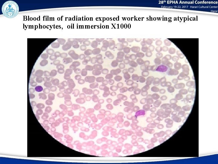 Blood film of radiation exposed worker showing atypical lymphocytes, oil immersion X 1000 