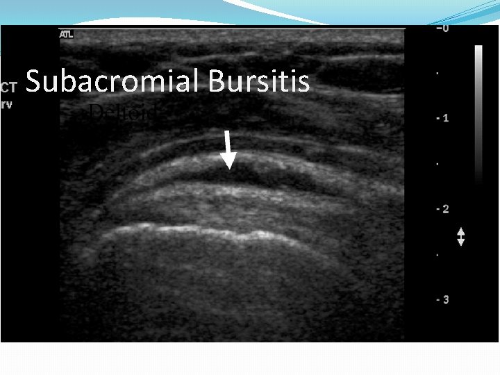 Subacromial Bursitis 