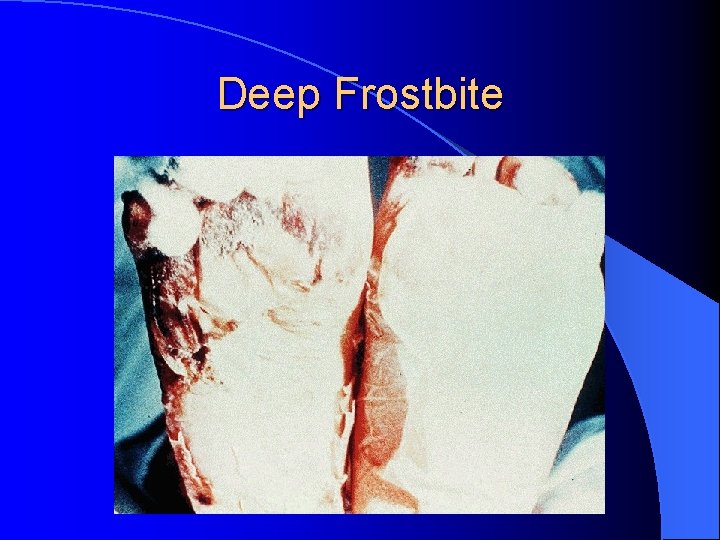 Deep Frostbite 