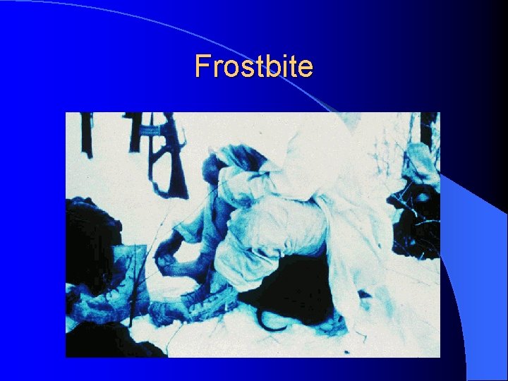 Frostbite 