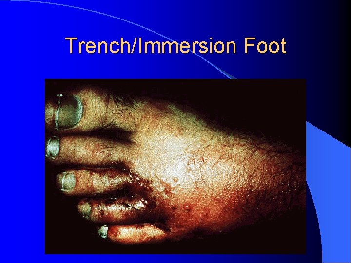 Trench/Immersion Foot 