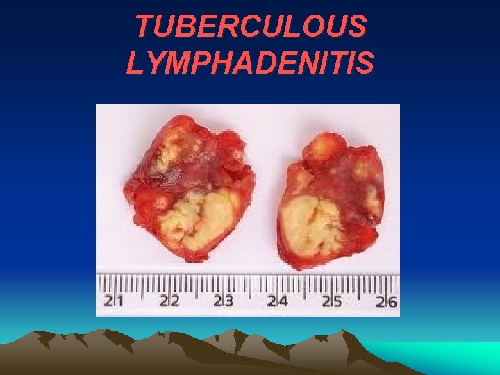 TUBERCULOUS LYMPHADENITIS 