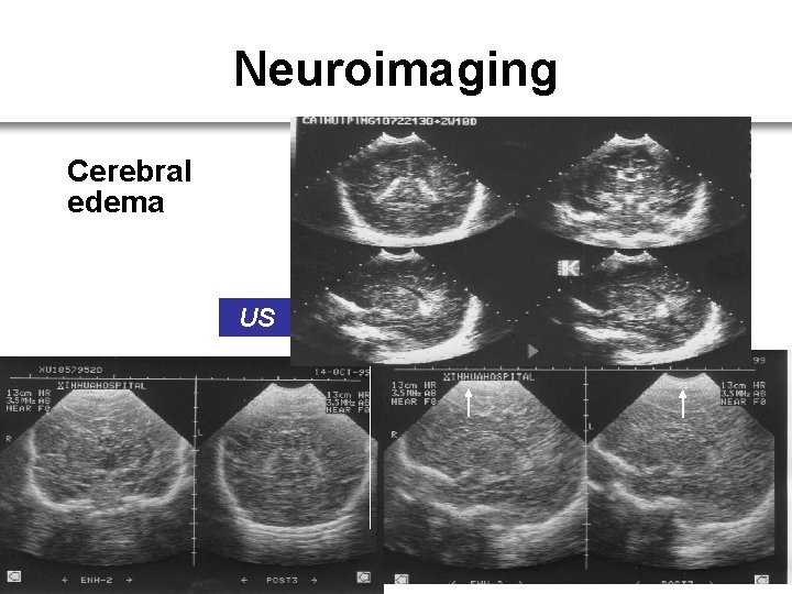 Neuroimaging Cerebral edema US 