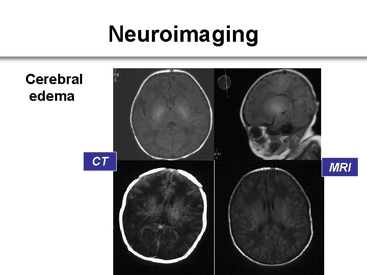 Neuroimaging Cerebral edema CT MRI 