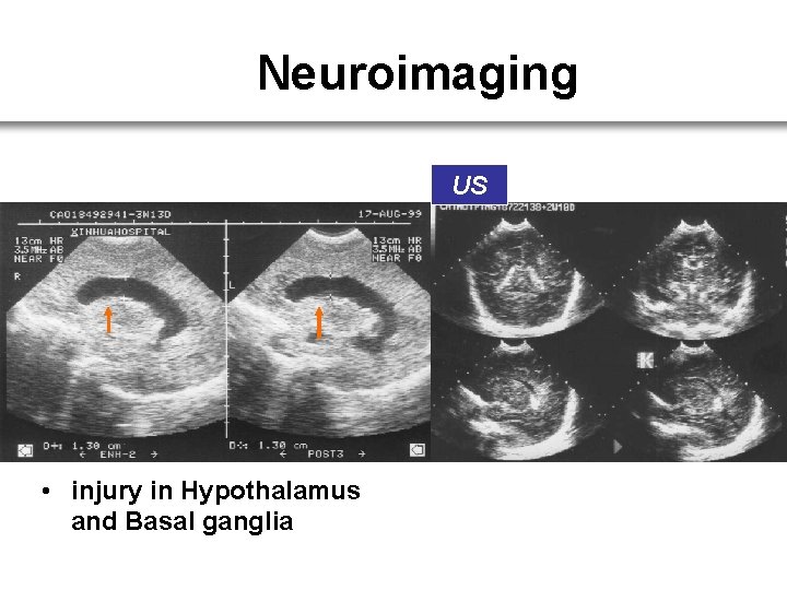 Neuroimaging US • injury in Hypothalamus and Basal ganglia 