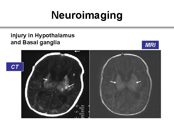 Neuroimaging injury in Hypothalamus and Basal ganglia CT MRI 